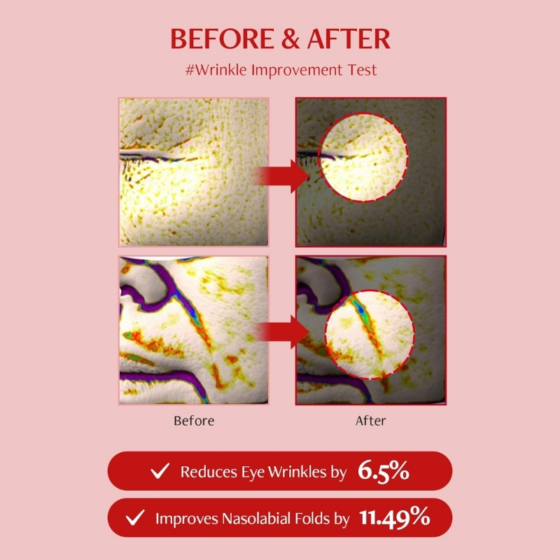 Before and after collage showing eye wrinkle reduction and nasolabial fold improvement, with percentages 6.5% and 11.49%.